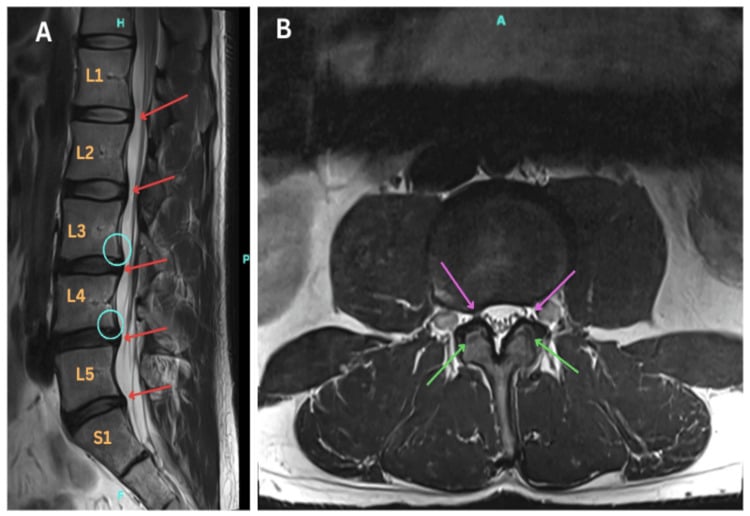 Sagittal T2 lumbar MRI showing multilevel disc degeneration and a short-segment stenosis that was incidental to the presenting diagnosis