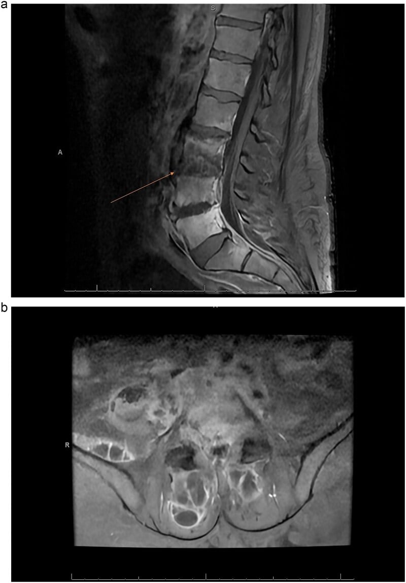 Contrast sagittal and axial lumbar MRI showing L3/4 and L4/5 discitis-osteomyelitis with an epidural abscess