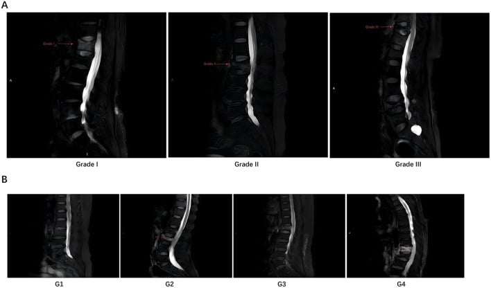 Sagittal lumbar MRI panels grading osteoporotic vertebral compression from I to III and posterior-wall involvement G1 to G4