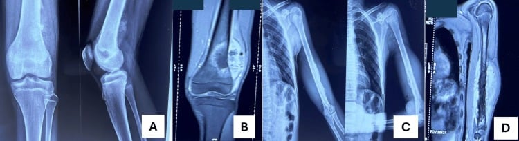 Radiographs and MRI showing destructive metaphyseal femoral and diaphyseal humeral malignant bone lesions.