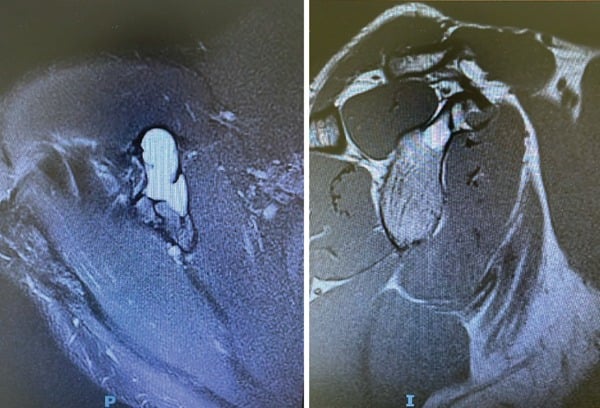 Shoulder MRI showing an aneurysmal bone cyst of the coracoid with septa and fluid-fluid levels.