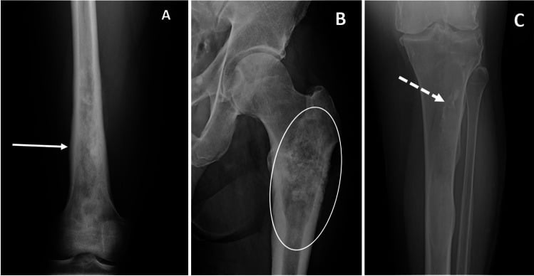 Radiographs showing osteoid, chondroid and fibrous matrix patterns in long-bone lesions.