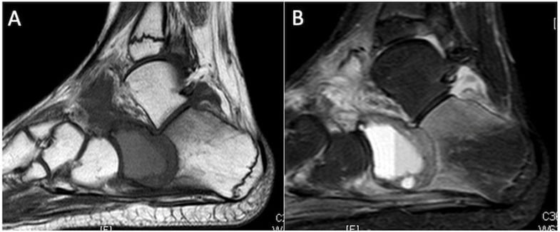 Sagittal T1 and STIR MRI showing a calcaneal chondroblastoma with extensive surrounding marrow oedema.