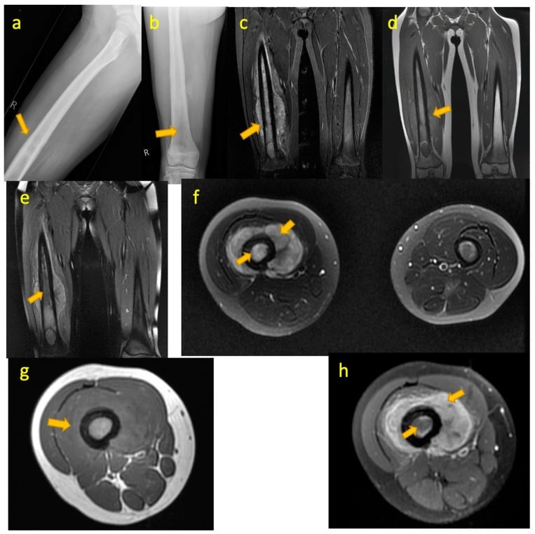 Femur radiographs and multiplanar MRI showing an aggressive permeative Ewing sarcoma with soft-tissue extension.