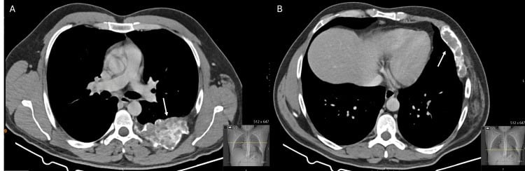 Axial chest CT images showing expansile fibrous dysplasia of anterior and posterior rib segments.