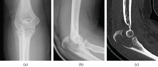 Elbow radiographs and sagittal CT showing an articular olecranon giant cell tumour with a displaced pathological fracture.