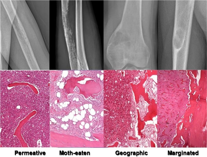 Four radiographs paired with histology showing permeative, moth-eaten, geographic and marginated bone-lesion patterns.