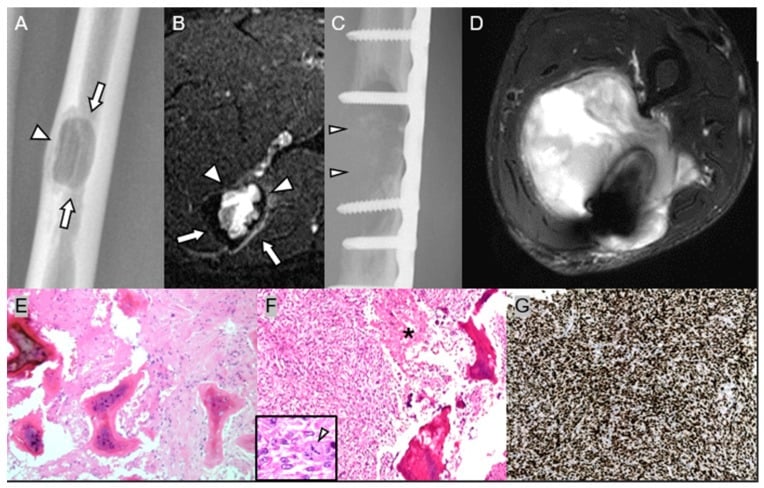 Radiograph, MRI, CT and histology showing high-grade dedifferentiation within a previously low-grade ulnar lesion.