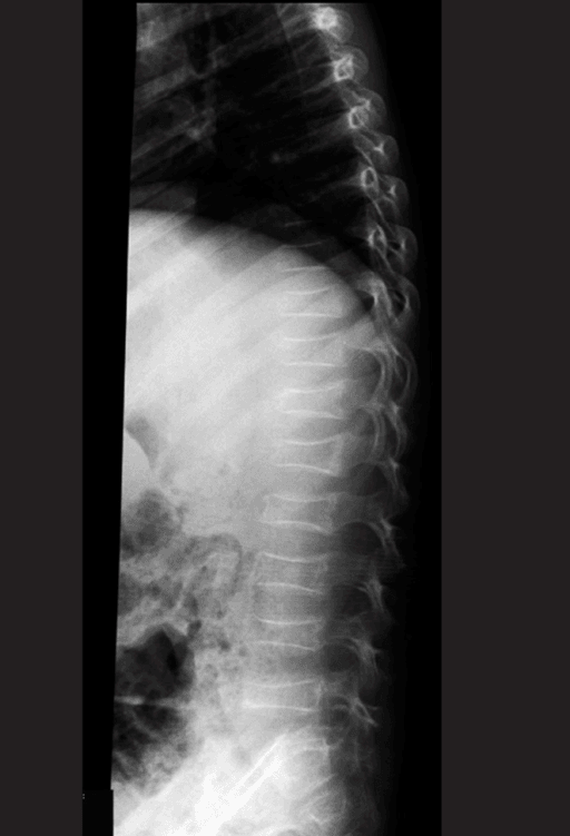 Lateral X-ray of thoracic and lumbar spine showing several flattened, collapsed vertebral bodies.
