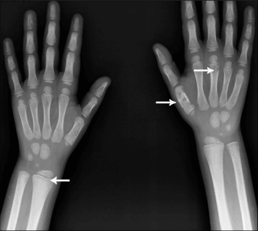 Paediatric wrist X-ray with lucent bands across the distal radial and ulnar metaphyses and lucency in the first metacarpal.