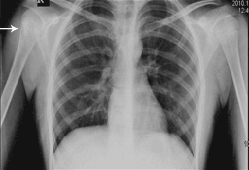 Chest X-ray with an arrow marking a permeative, moth-eaten lucent lesion in the right humerus.