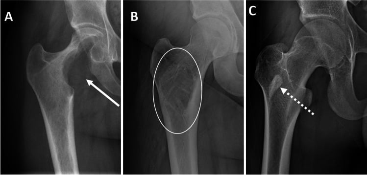Three proximal femur radiographs showing lucent, mixed and sclerotic lesion density patterns.