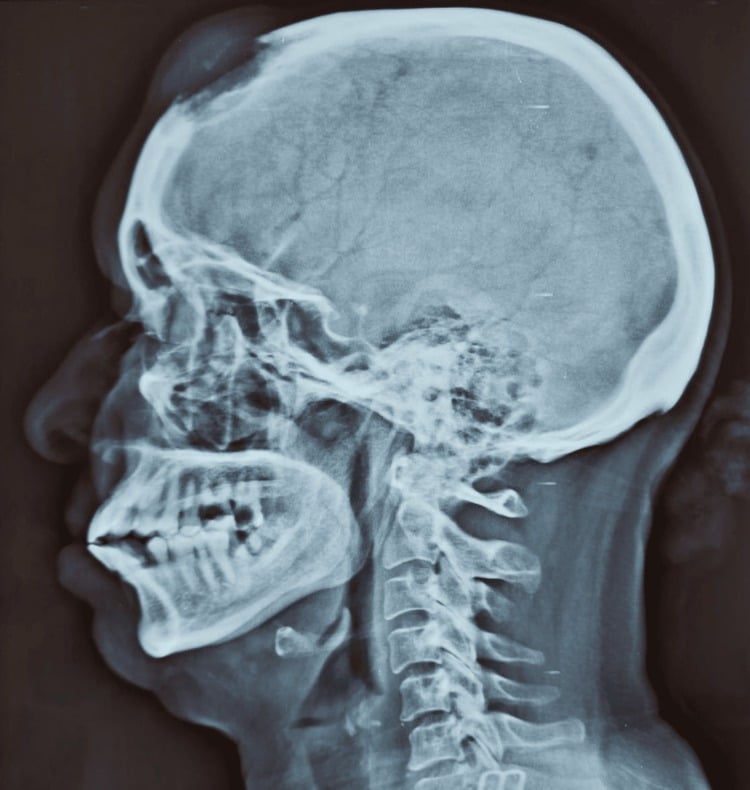 Lateral skull radiograph showing a destructive frontal bone lytic metastasis with soft-tissue extension.