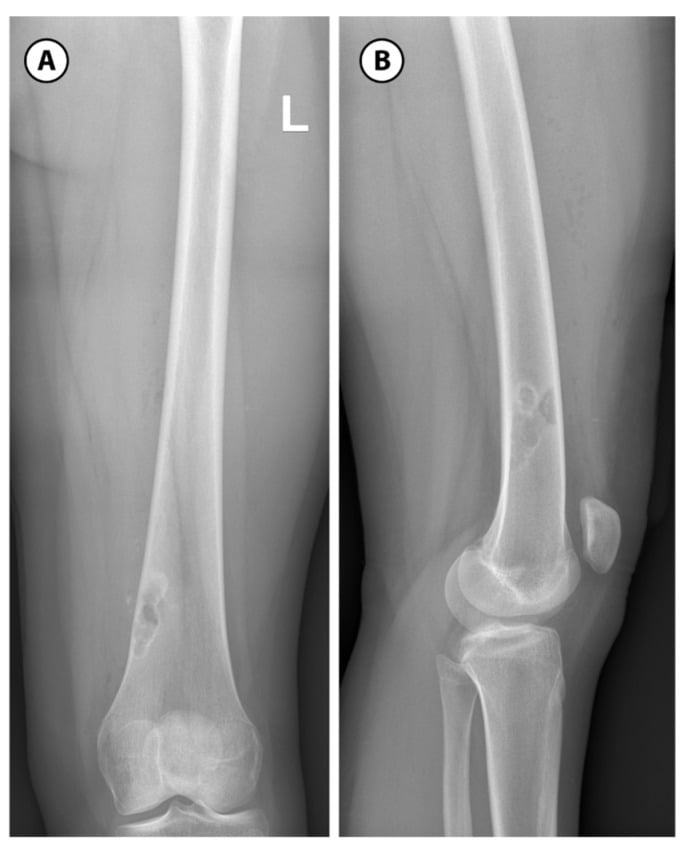 AP and lateral distal femur radiographs showing an eccentric metaphyseal non-ossifying fibroma with a sclerotic rim.
