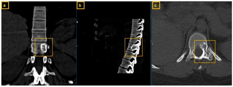 Axial, coronal and sagittal CT showing an osteoid osteoma nidus at a thoracic pedicle.
