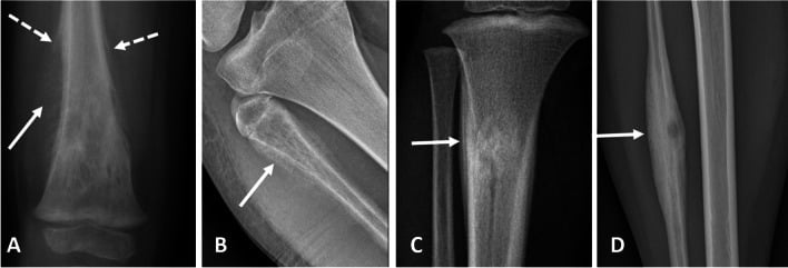 Four radiographs showing disorganised, Codman triangle, lamellated and solid periosteal reactions.