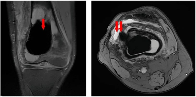 Sagittal and axial MRI showing telangiectatic osteosarcoma with fluid-fluid levels and irregular enhancement.