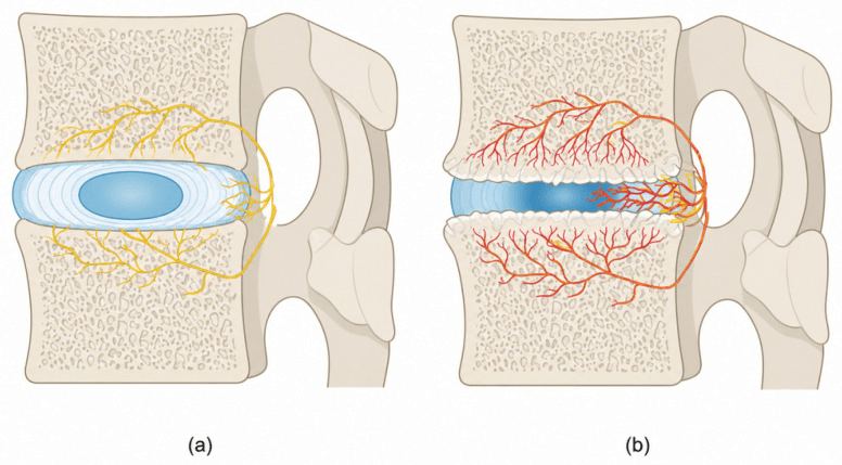 Normal and degenerate intervertebral disc, the degenerate disc showing vessel and nerve ingrowth