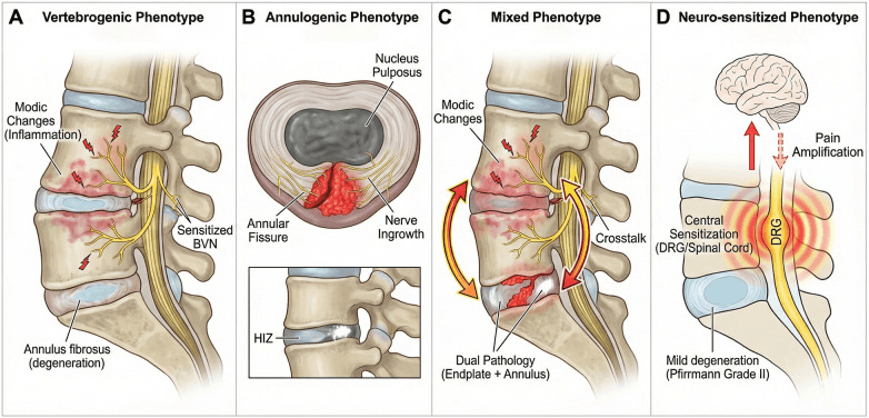 Four-panel schematic of vertebrogenic, annulogenic, mixed and neuro-sensitised low back pain phenotypes