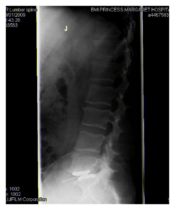 Lateral radiograph of a lumbar disc prosthesis with a dislocated polyethylene inlay