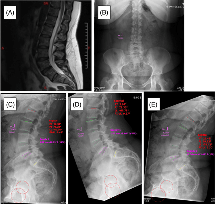 Sagittal MRI, AP radiograph and erect neutral, flexion and extension lateral radiographs with translation that changes between films