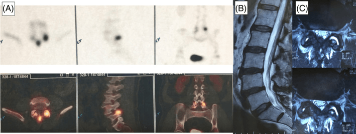 Bone scintigraphy and fused tracer-CT images localising uptake to a lumbar facet joint, with sagittal and axial MRI