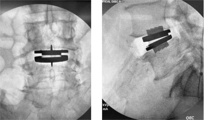 Anteroposterior and lateral intraoperative fluoroscopy showing final ProDisc-L positioning