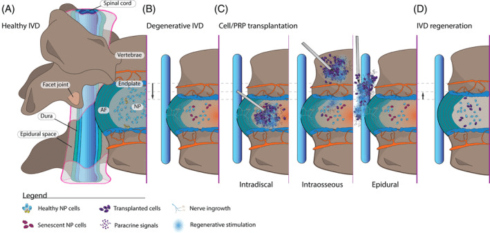 Four-panel schematic of a healthy and a degenerative lumbar disc, followed by cell or PRP transplantation routes and disc regeneration
