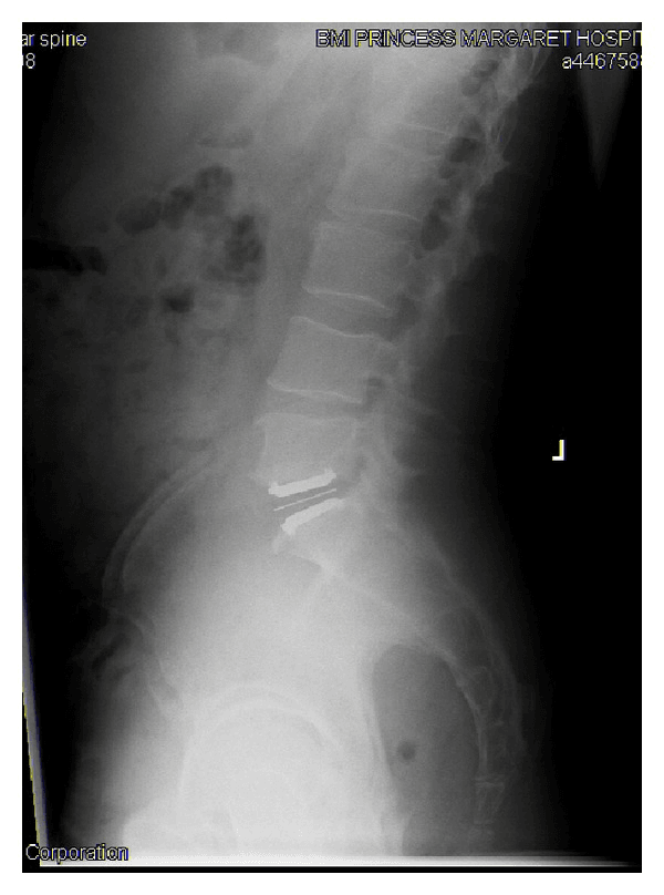 Lateral lumbar radiograph showing a total disc prosthesis in the lower lumbar spine
