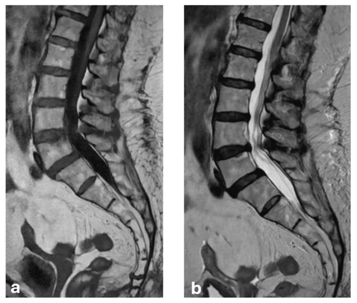 Paired sagittal lumbar MRIs showing Modic type 1 endplate change
