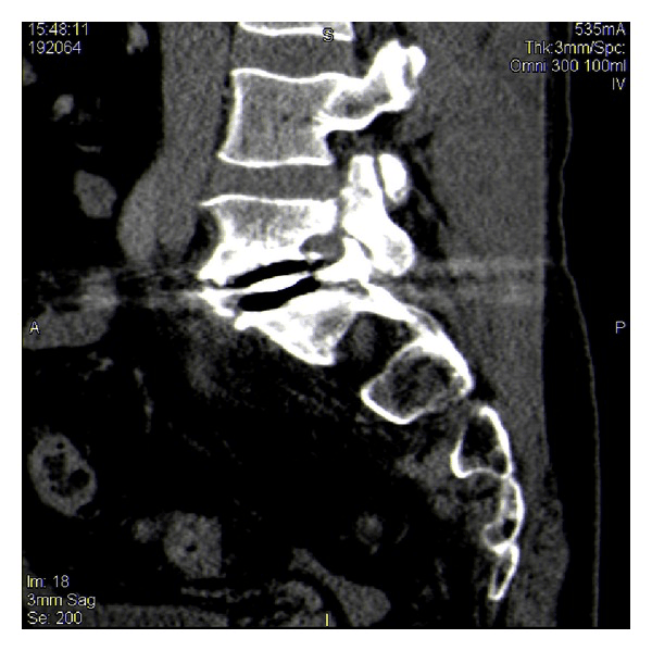 Sagittal CT showing an L5 pedicle fracture after lumbar disc replacement