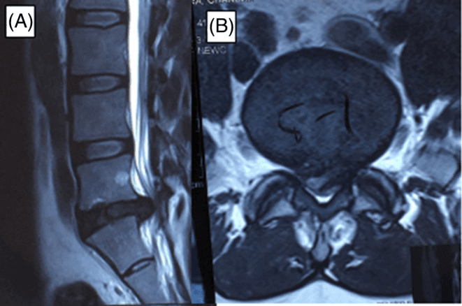 Sagittal and axial lumbar MRI showing a large central disc herniation completely compressing the thecal sac