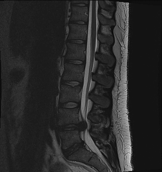 Sagittal T2-weighted MRI showing severe L4-L5 disc herniation