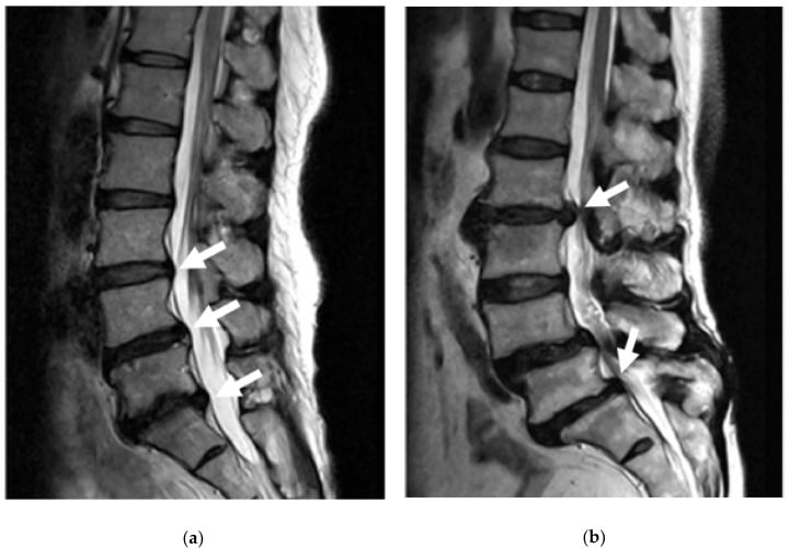 MRI comparison showing mild disc bulge versus full lumbar disc herniation with spinal stenosis
