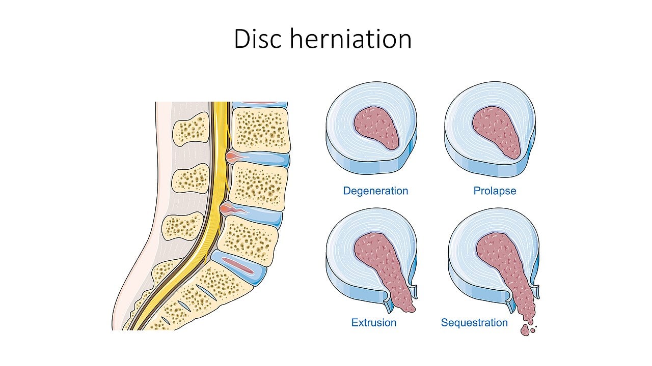 Diagram showing the four stages of disc herniation: degeneration, prolapse, extrusion, and sequestration