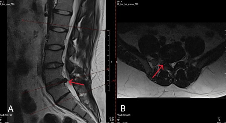 Sagittal and axial T2 MRI of L4-L5 lumbar disc extrusion and subarticular nerve root compression
