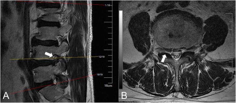 Sagittal and axial MRI views demonstrating L4-L5 foraminal stenosis
