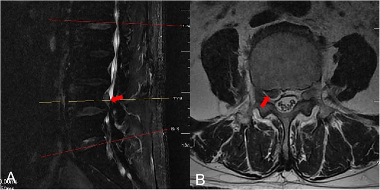 Sagittal and axial MRI of extruded and sequestered L4-L5 lumbar disc fragment