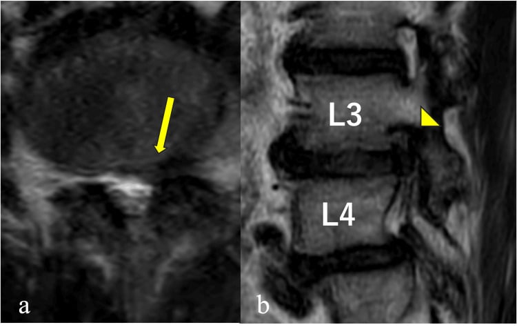 Axial and sagittal T2 MRI demonstrating far lateral L3-L4 foraminal disc herniation