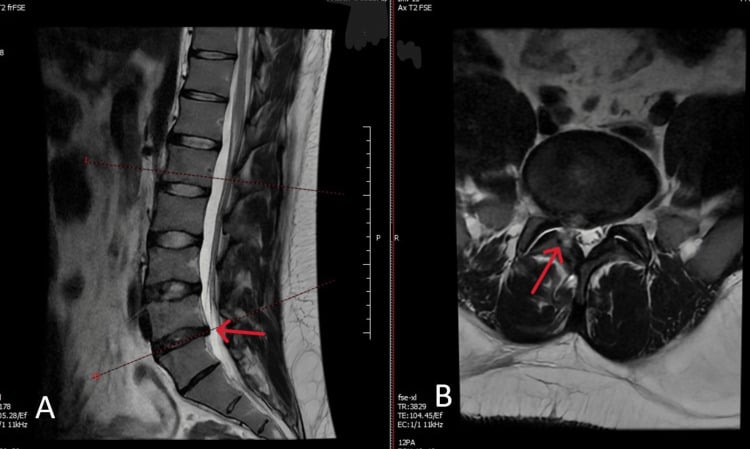 Postoperative sagittal and axial T2 MRI showing complete L4-L5 microdiscectomy decompression
