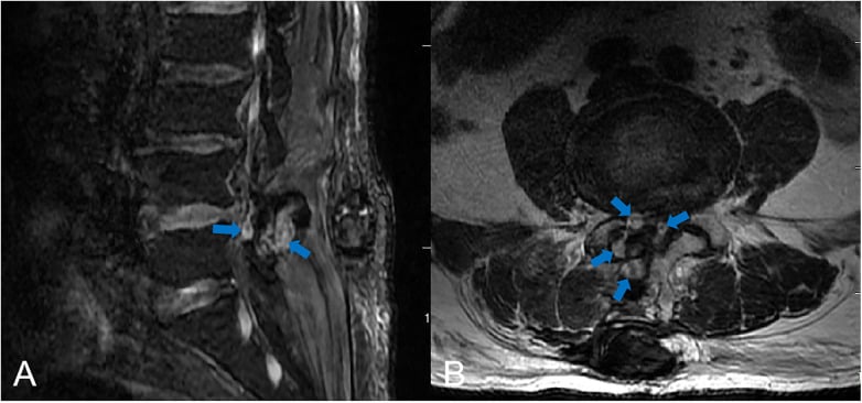 Postoperative lumbar MRI demonstrating an epidural hematoma compressing the dural sac