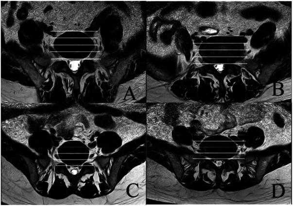Axial lumbar MRI examples mapping common and internal iliac veins relative to four anterior disc-space zones for L4-L5 and L5-S1 access planning