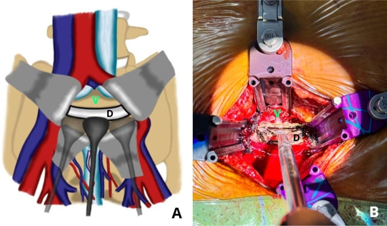 Anterior lumbar discectomy illustration and operative view showing posterior annular release with a flat Cobb elevator