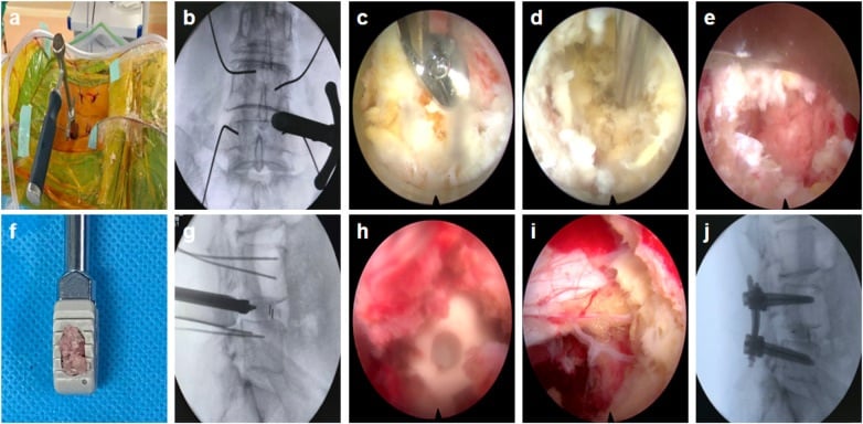 Endoscopic PLIF sequence showing working-channel placement decompression disc preparation grafting cage insertion and pedicle screws