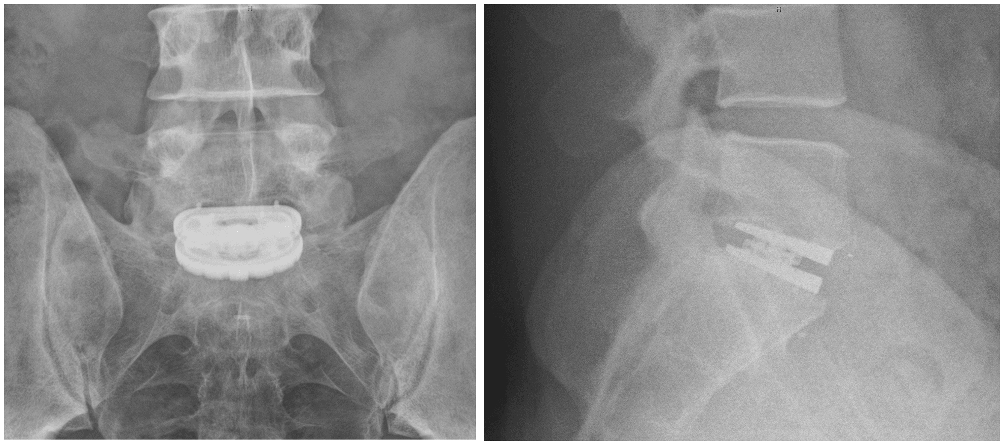 AP and lateral radiographs of an L5-S1 interbody fusion cage.