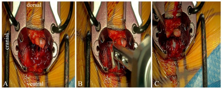 Retractor view showing lateral discectomy cage introduction and final cage position
