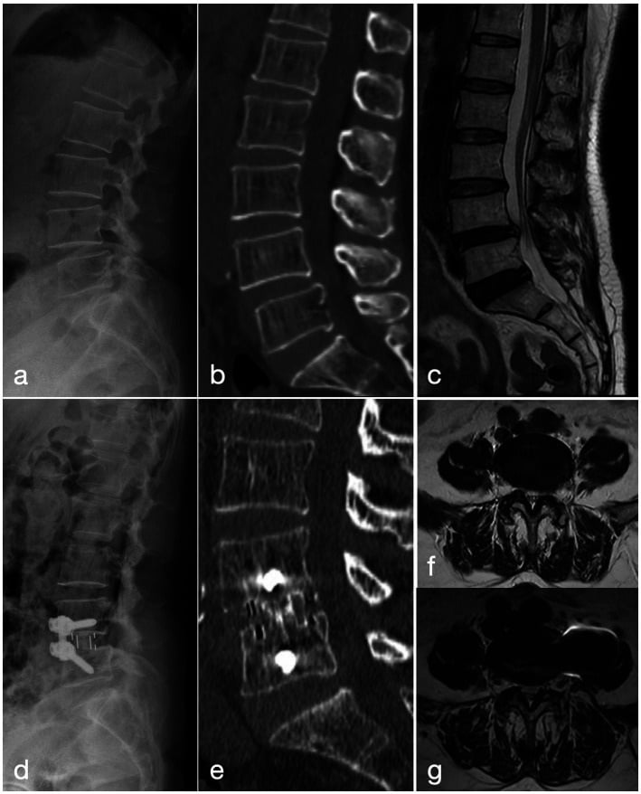 Preoperative radiograph CT and MRI with postoperative OLIF and anterior fixation imaging for grade I L4 spondylolisthesis