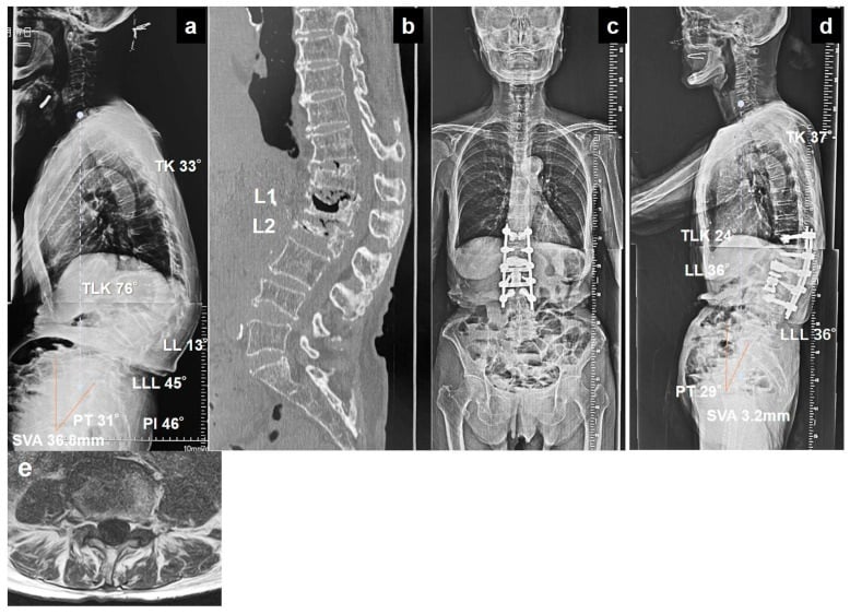 Standing radiographs and CT of osteoporotic deformity treated with short cement-augmented posterior fixation