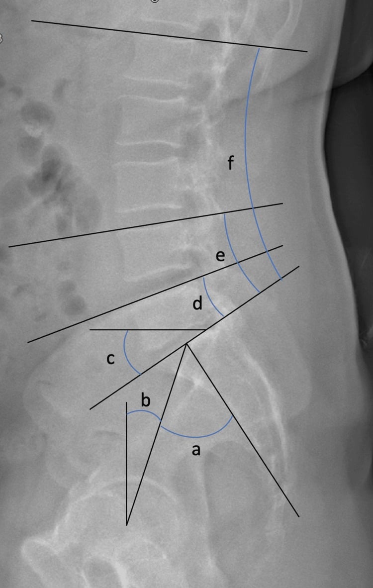 EOS lateral radiograph showing pelvic incidence tilt sacral slope and regional lumbar lordosis measurements