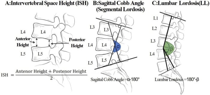 Lateral lumbar radiographic diagrams for disc height segmental Cobb angle and lumbar lordosis measurement